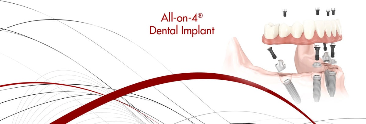 Anthony Dental Services - Decatur, AL, US, dental implants