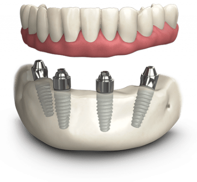 Dentist - Jacksonville, AL, US, teeth