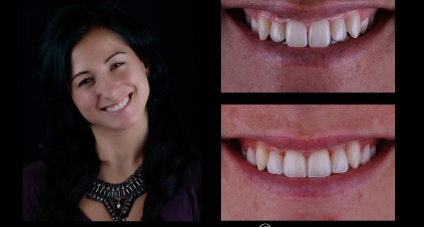 Huntington Bay Dental Larissa Figari Goller DDS, US, tooth cavity