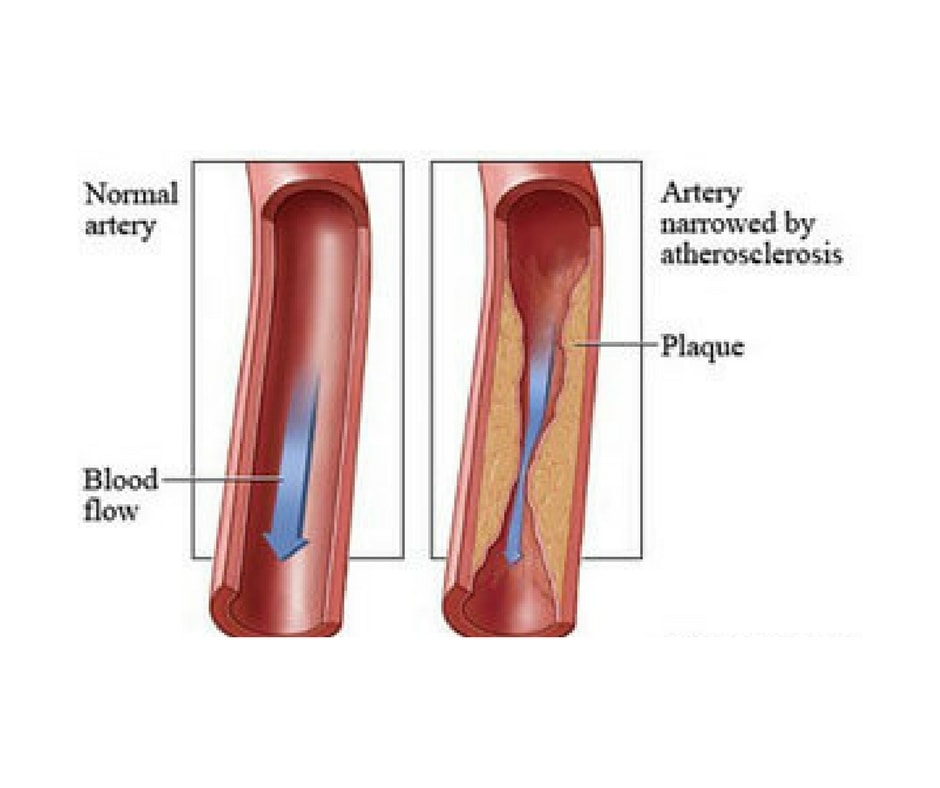 USA Vascular Centers - Jersey City, NJ, US, femoral artery